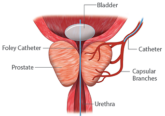 Ce este o prostată mărită?